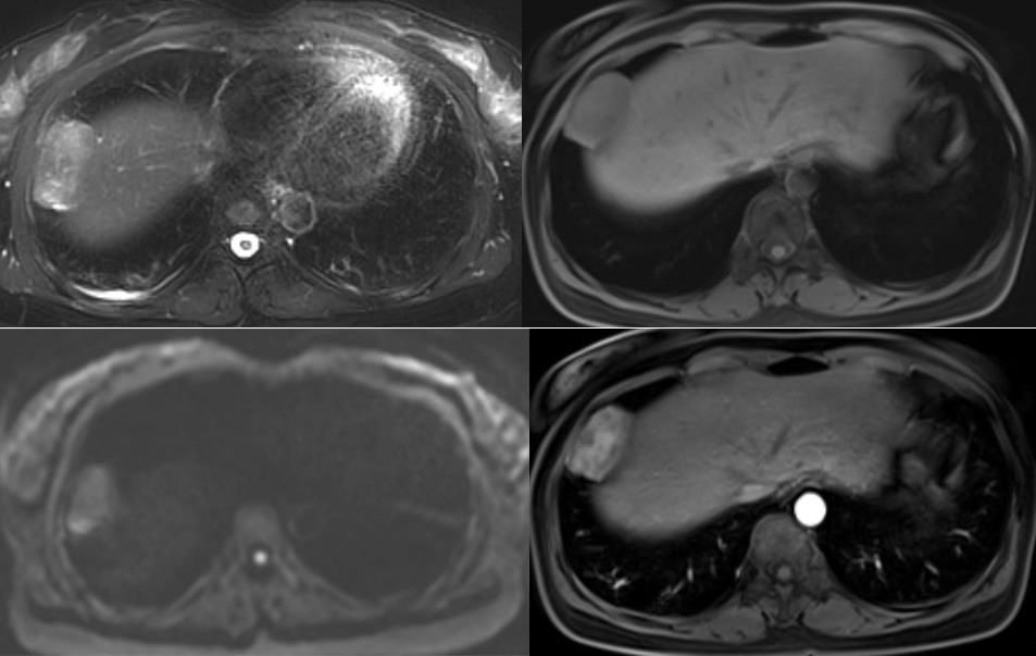 胸膜解剖及胸膜孤立性纤维瘤的 CT 诊断