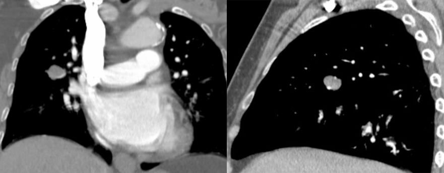 胸膜解剖及胸膜孤立性纤维瘤的 CT 诊断