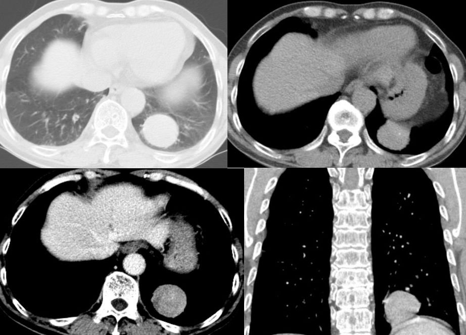 胸膜解剖及胸膜孤立性纤维瘤的 CT 诊断