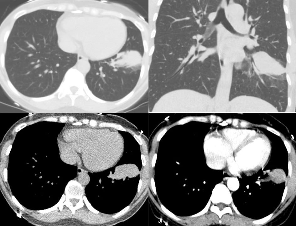 胸膜解剖及胸膜孤立性纤维瘤的 CT 诊断