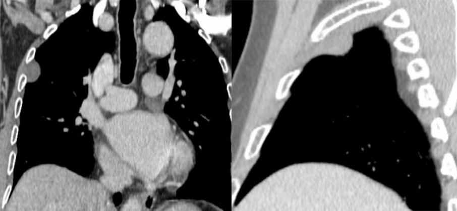 胸膜解剖及胸膜孤立性纤维瘤的 CT 诊断