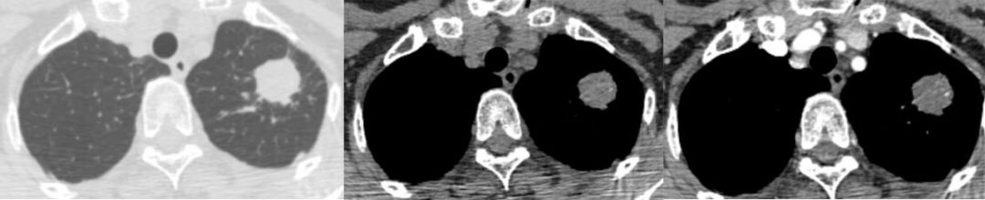 胸膜解剖及胸膜孤立性纤维瘤的 CT 诊断