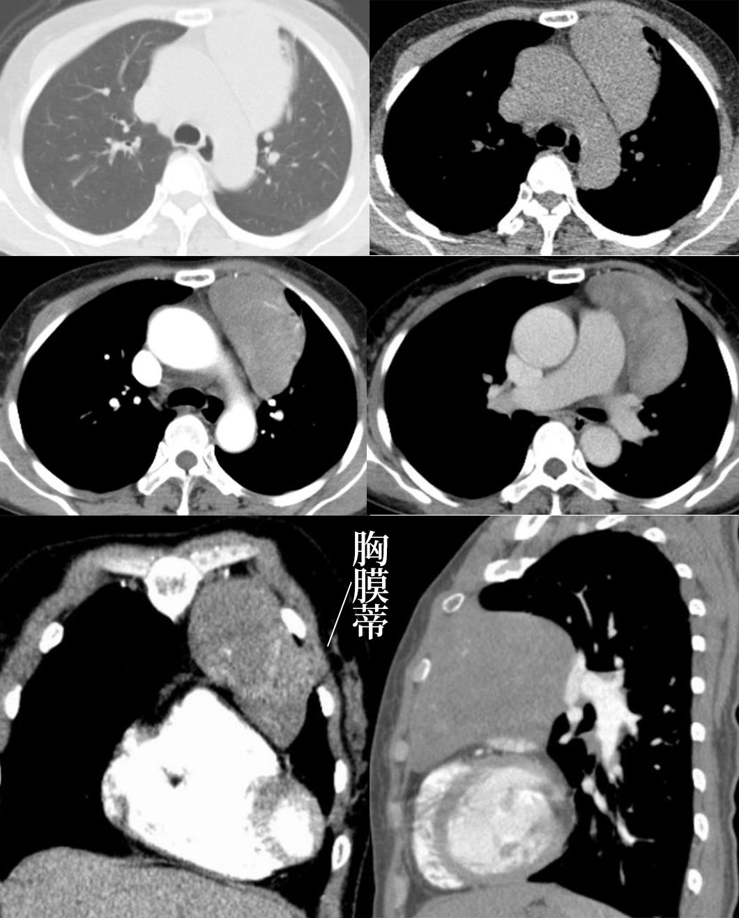 胸膜解剖及胸膜孤立性纤维瘤的 CT 诊断