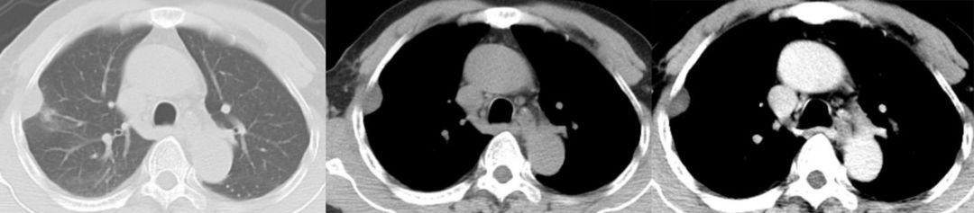 胸膜解剖及胸膜孤立性纤维瘤的 CT 诊断