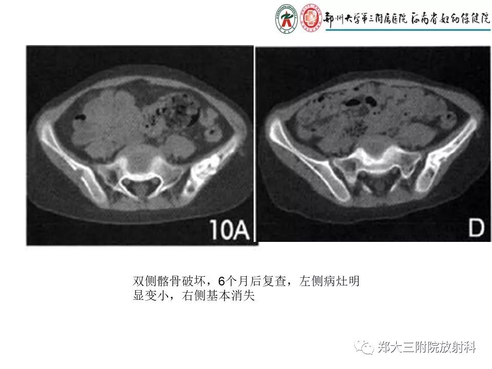 【PPT】儿童朗格汉斯细胞增生症的影像学表现