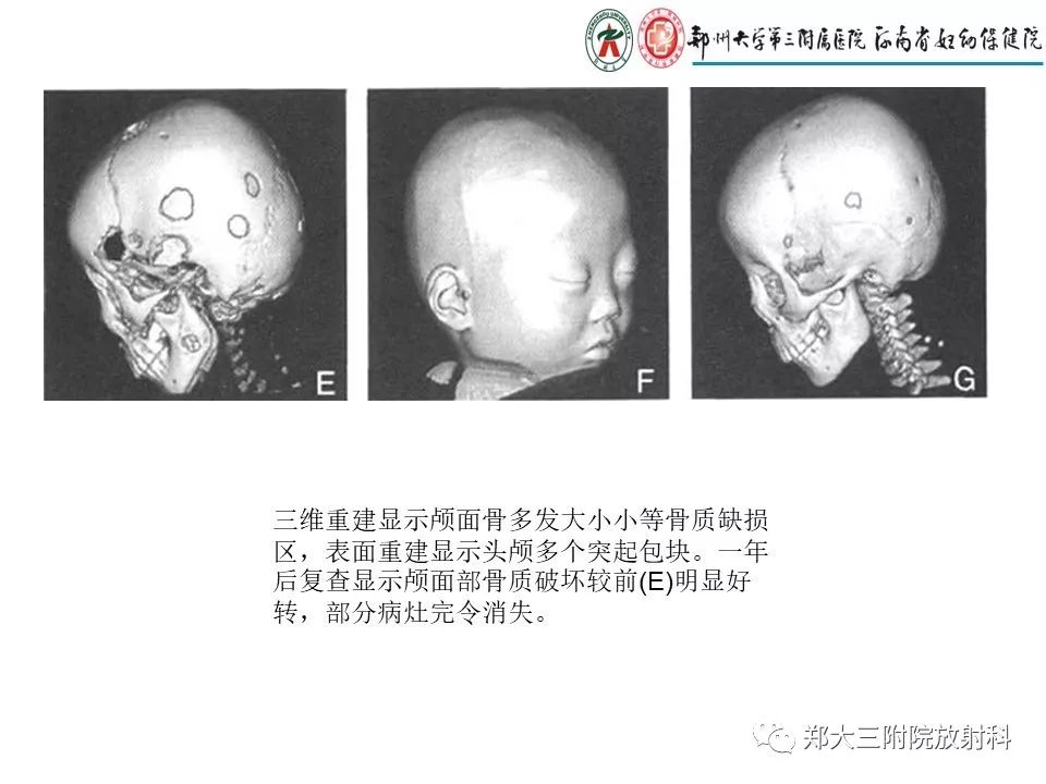 【PPT】儿童朗格汉斯细胞增生症的影像学表现