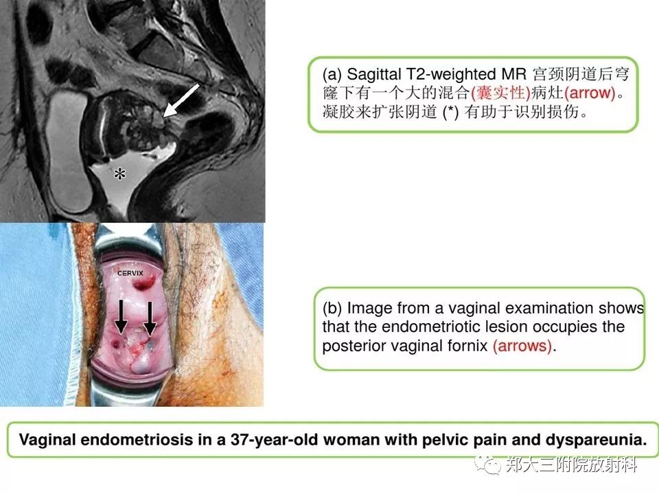 【病例】一例有内膜癌的子宫腺肌症MR
