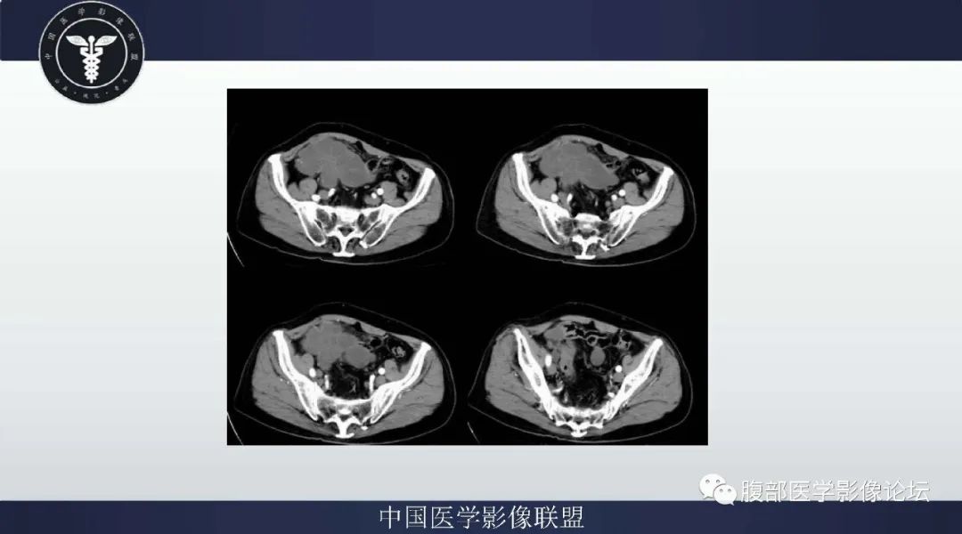 【病例】阑尾黏液腺癌1例CT及MR影像