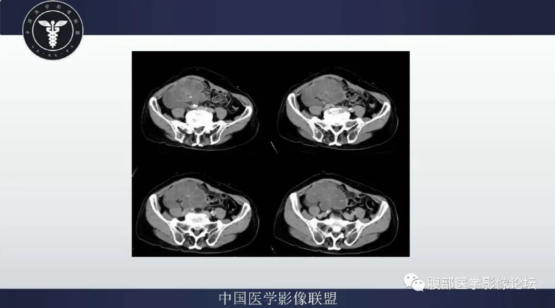 【病例】阑尾黏液腺癌1例CT及MR影像