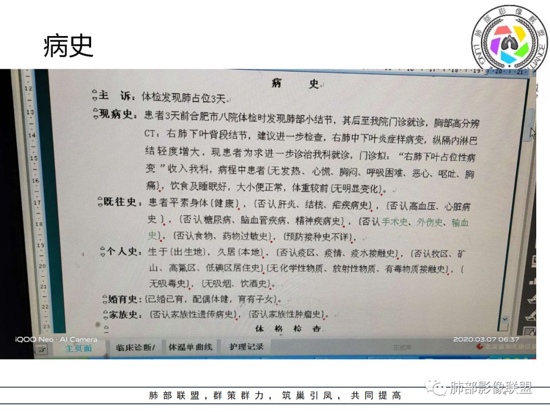 【病例】结核居然也能有晕征 【病例】结核居然也能有晕征