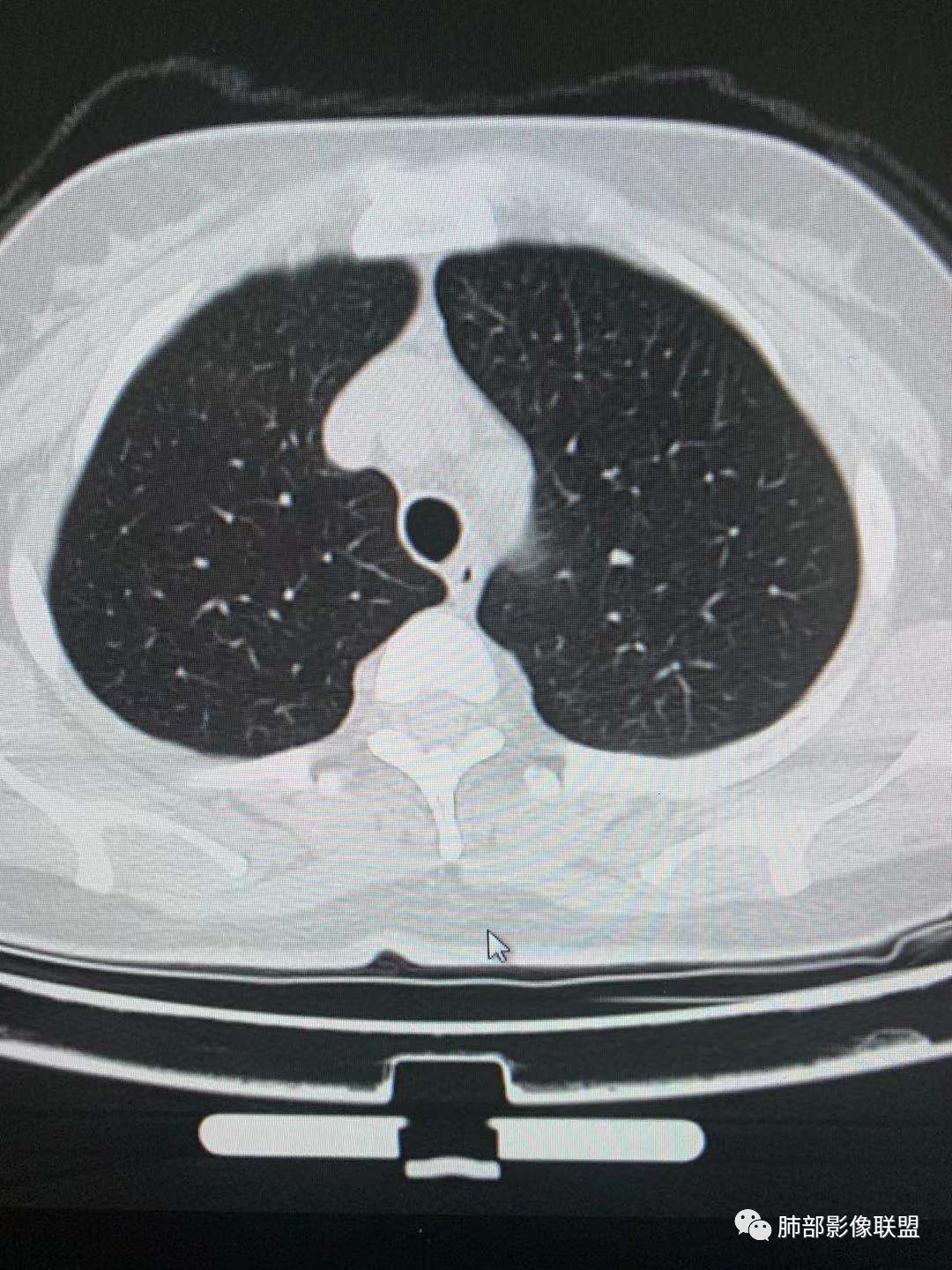 【病例】犹抱琵笆半遮面的肺腺癌