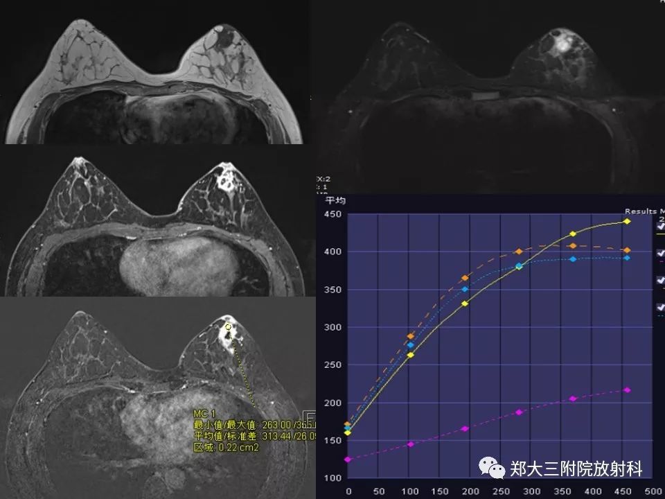 【PPT】非哺乳期乳腺炎症与炎性乳癌的影像鉴别诊断