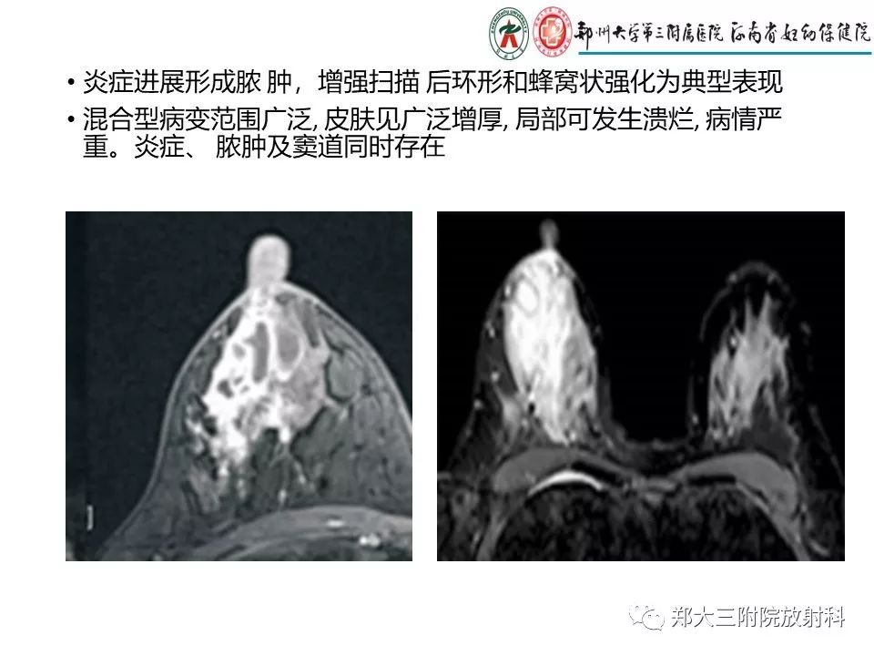 【PPT】非哺乳期乳腺炎症与炎性乳癌的影像鉴别诊断