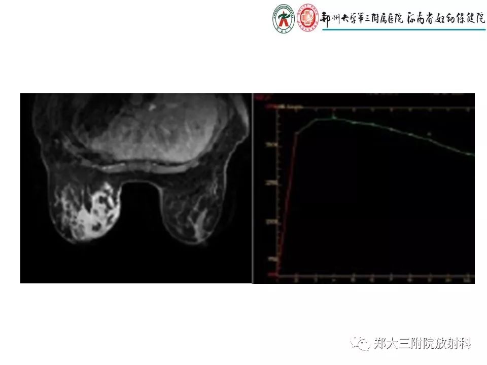 【PPT】非哺乳期乳腺炎症与炎性乳癌的影像鉴别诊断