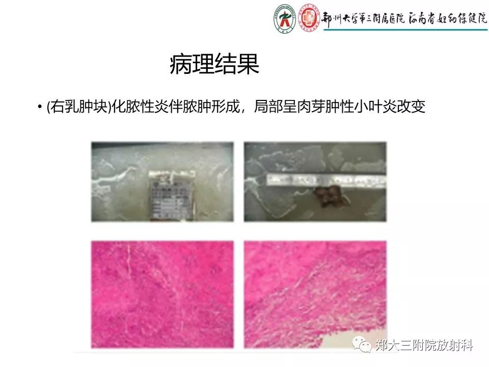 【PPT】非哺乳期乳腺炎症与炎性乳癌的影像鉴别诊断