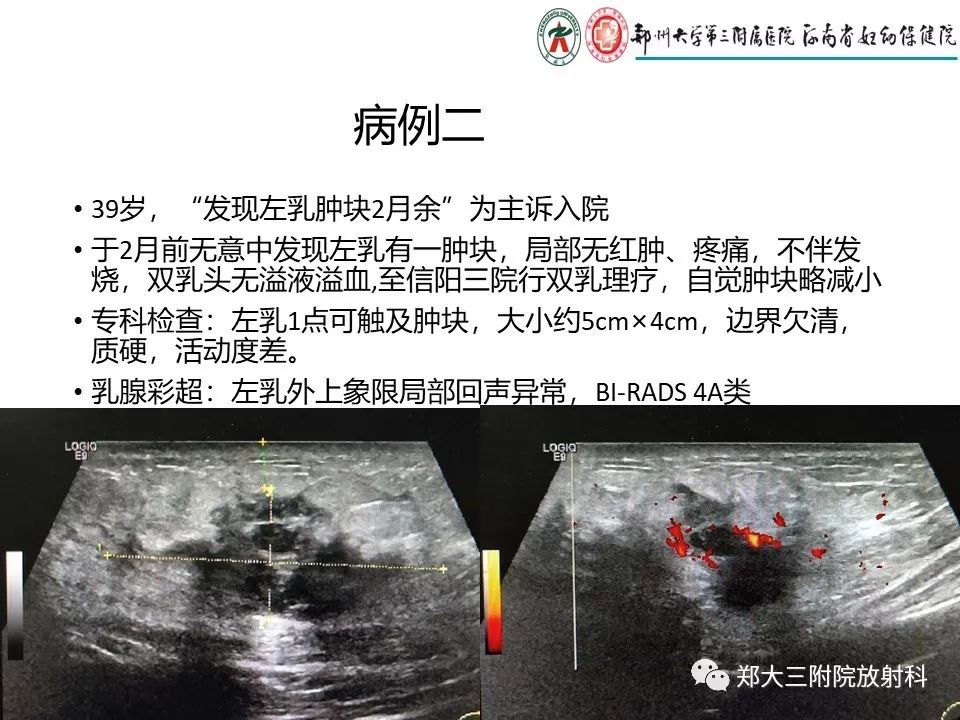 【PPT】非哺乳期乳腺炎症与炎性乳癌的影像鉴别诊断