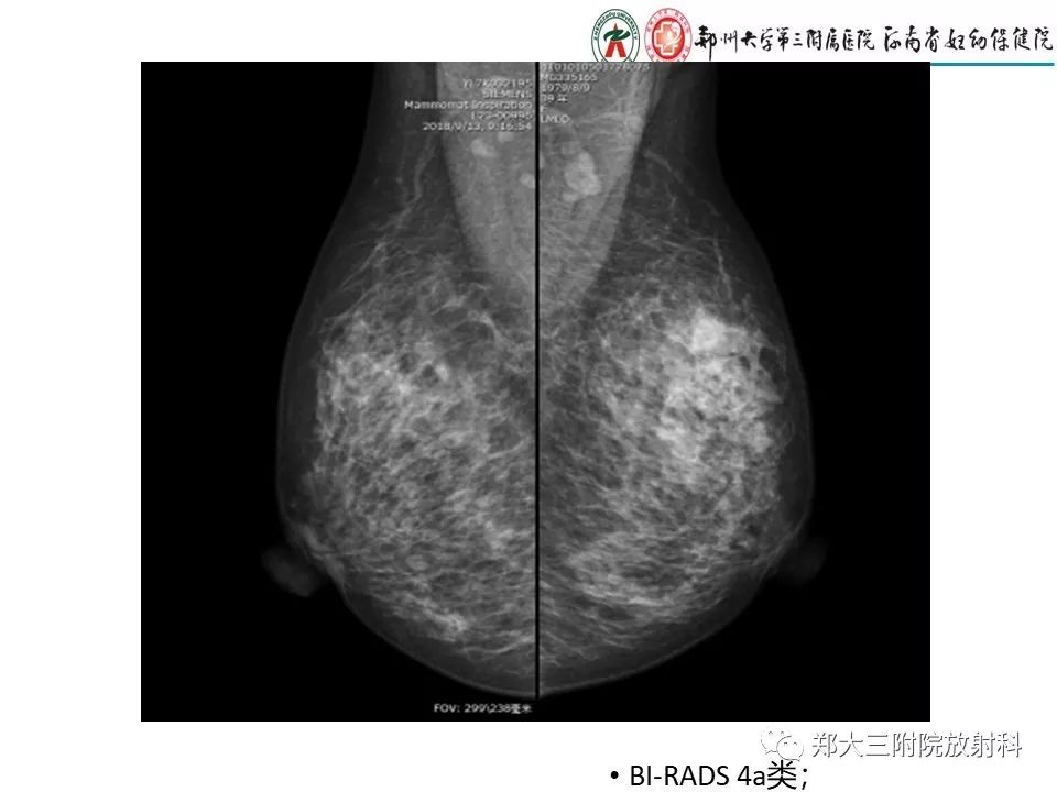 【PPT】非哺乳期乳腺炎症与炎性乳癌的影像鉴别诊断