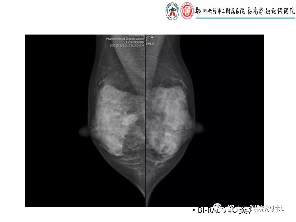 【PPT】非哺乳期乳腺炎症与炎性乳癌的影像鉴别诊断