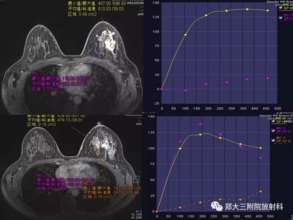 【PPT】非哺乳期乳腺炎症与炎性乳癌的影像鉴别诊断