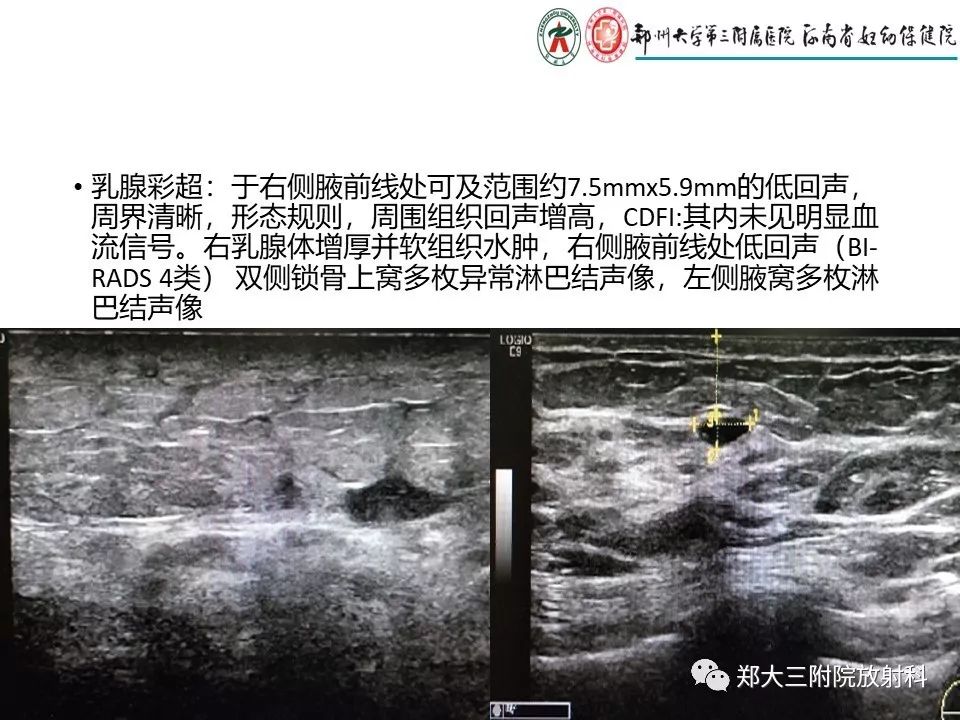 【PPT】非哺乳期乳腺炎症与炎性乳癌的影像鉴别诊断