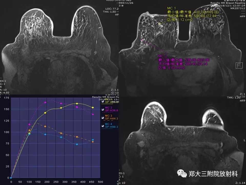 【PPT】非哺乳期乳腺炎症与炎性乳癌的影像鉴别诊断