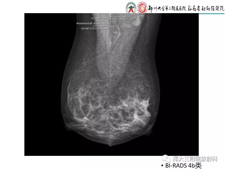 【PPT】非哺乳期乳腺炎症与炎性乳癌的影像鉴别诊断