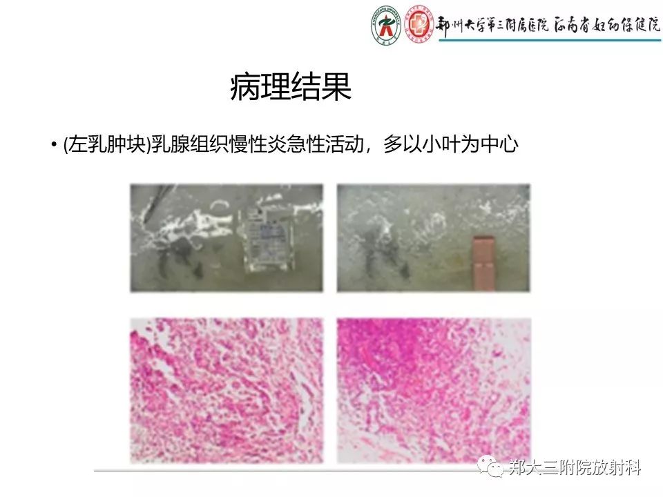 【PPT】非哺乳期乳腺炎症与炎性乳癌的影像鉴别诊断