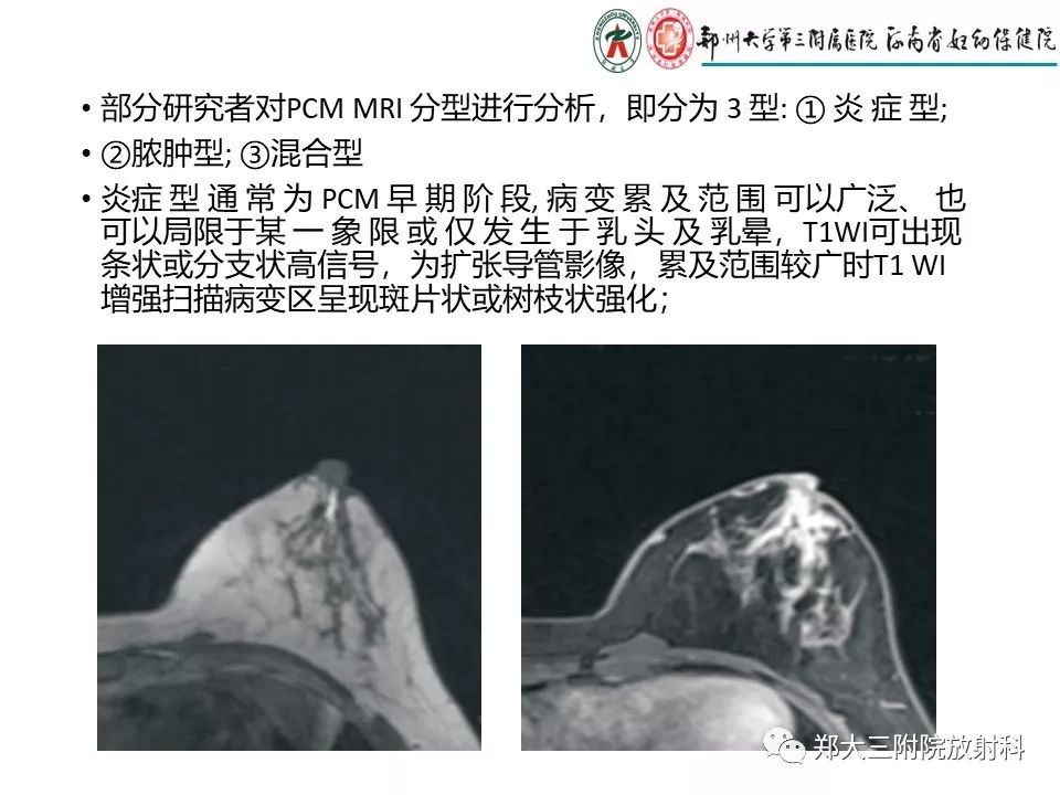 【PPT】非哺乳期乳腺炎症与炎性乳癌的影像鉴别诊断