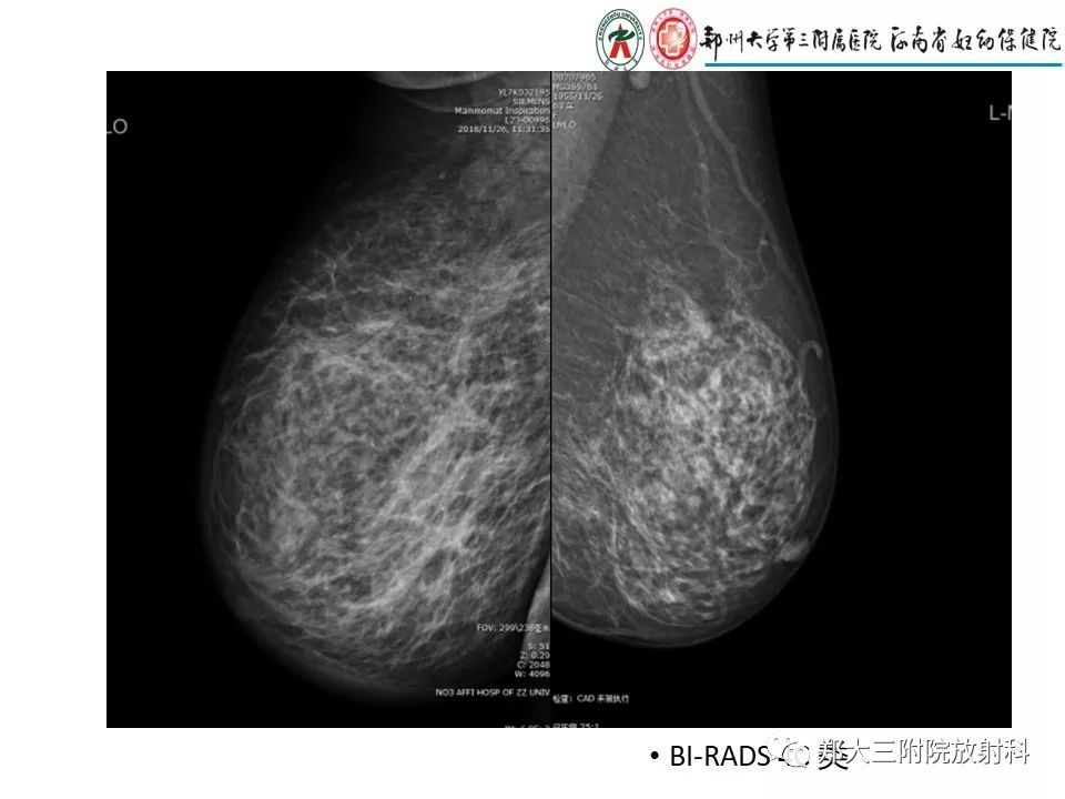 【PPT】非哺乳期乳腺炎症与炎性乳癌的影像鉴别诊断