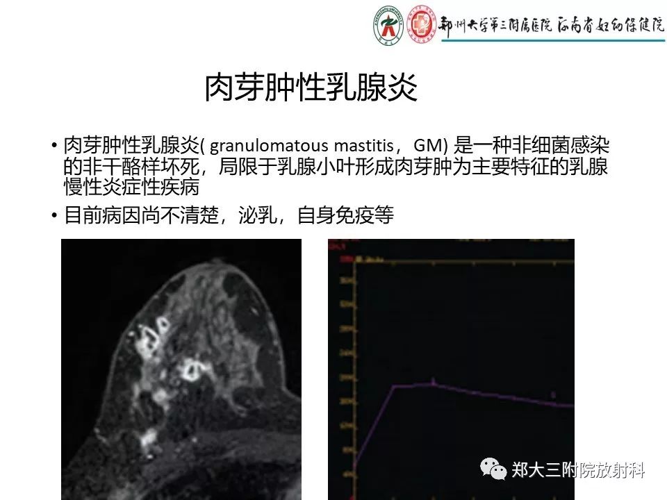 【PPT】非哺乳期乳腺炎症与炎性乳癌的影像鉴别诊断