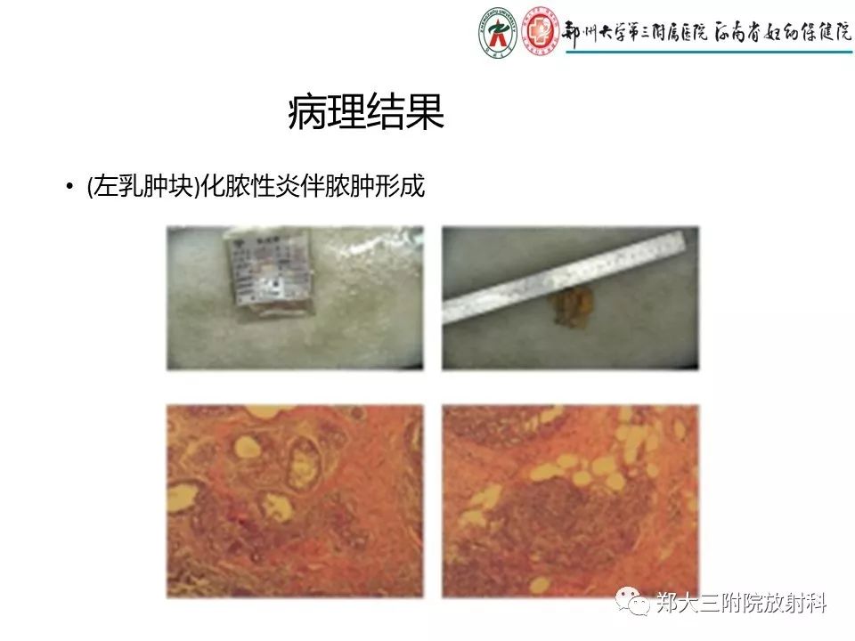 【PPT】非哺乳期乳腺炎症与炎性乳癌的影像鉴别诊断