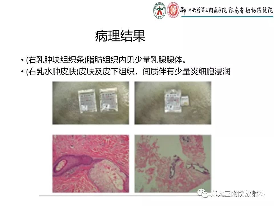 【PPT】非哺乳期乳腺炎症与炎性乳癌的影像鉴别诊断