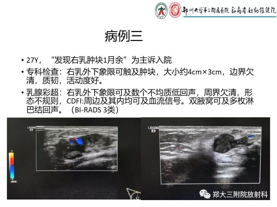 【PPT】非哺乳期乳腺炎症与炎性乳癌的影像鉴别诊断