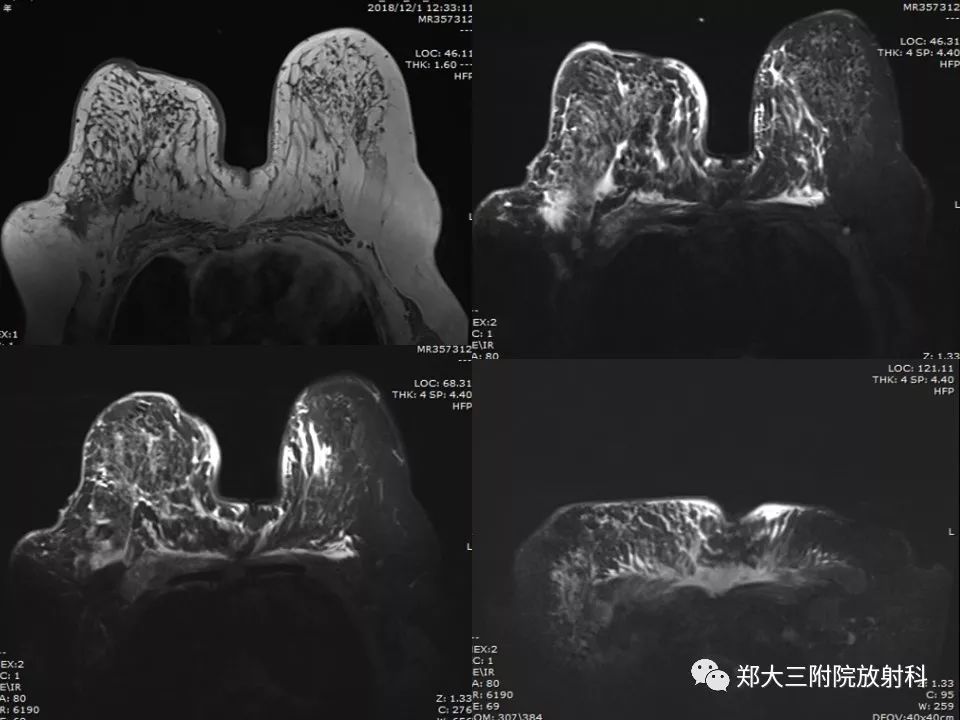 【PPT】非哺乳期乳腺炎症与炎性乳癌的影像鉴别诊断