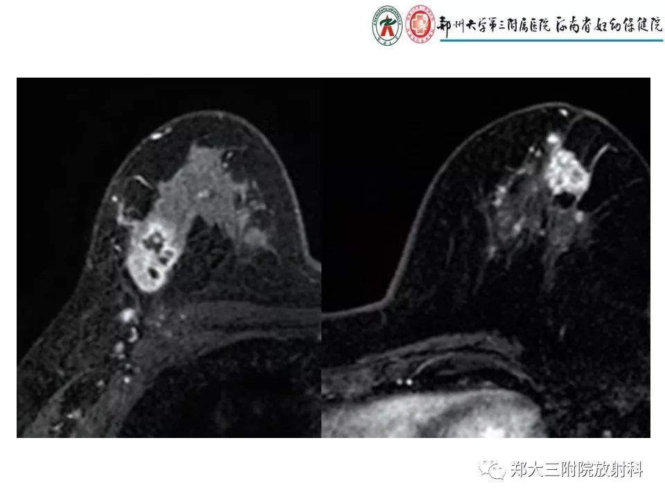【PPT】非哺乳期乳腺炎症与炎性乳癌的影像鉴别诊断