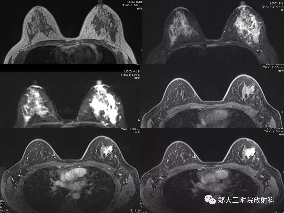 【PPT】非哺乳期乳腺炎症与炎性乳癌的影像鉴别诊断