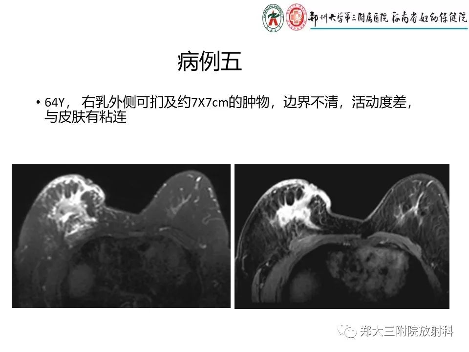 【PPT】非哺乳期乳腺炎症与炎性乳癌的影像鉴别诊断