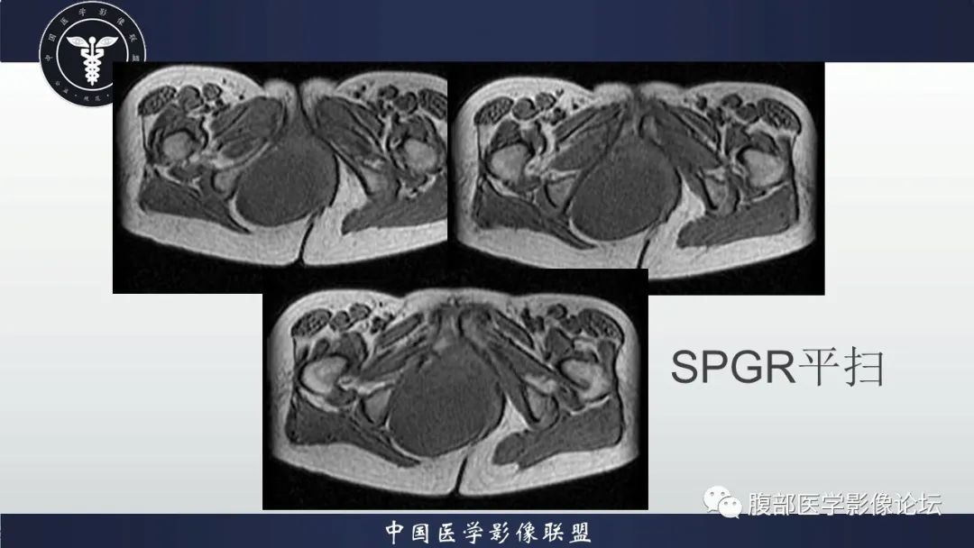 【病例】盆腔囊性成熟性畸胎瘤1例MR