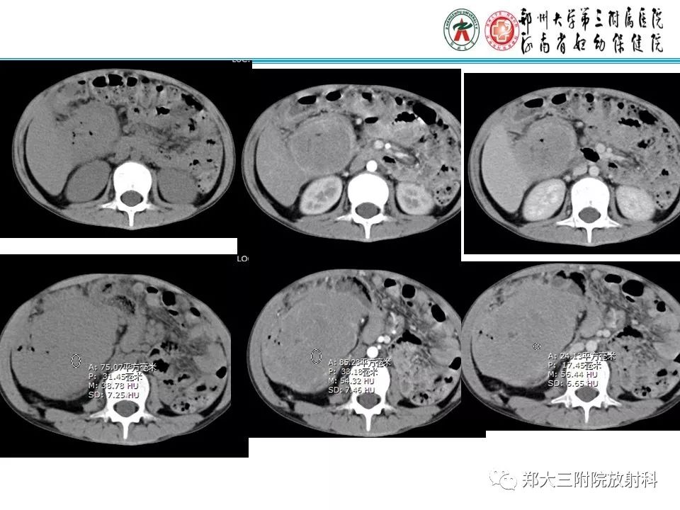 【PPT】小儿腹部伯基特Burkitt's淋巴瘤