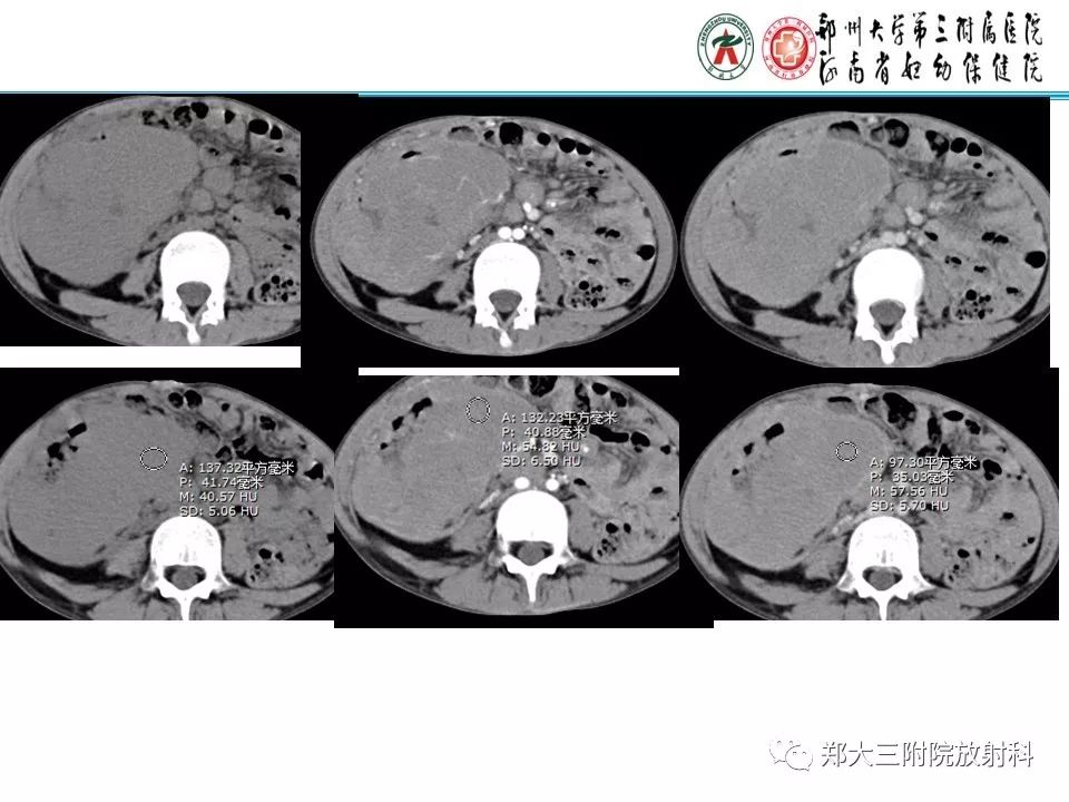 【PPT】小儿腹部伯基特Burkitt's淋巴瘤