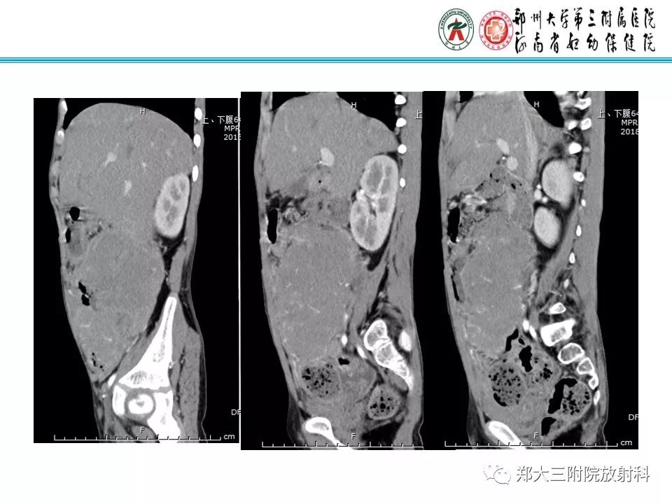 【PPT】小儿腹部伯基特Burkitt's淋巴瘤