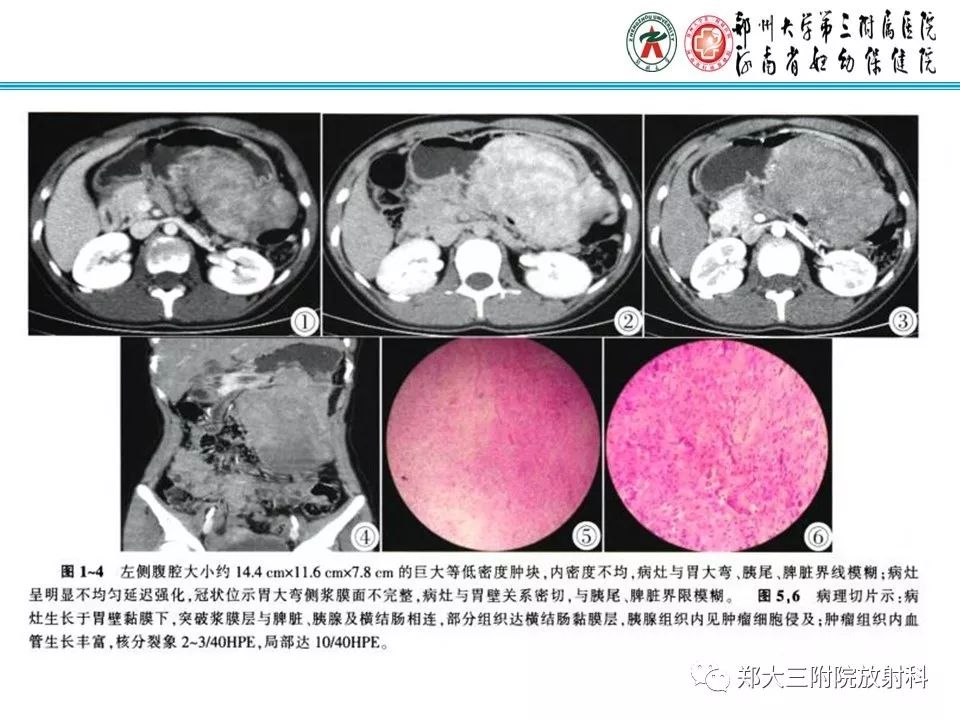 【PPT】小儿腹部伯基特Burkitt's淋巴瘤