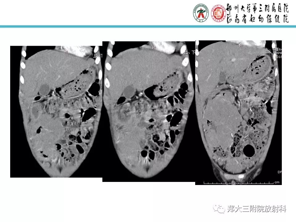 【PPT】小儿腹部伯基特Burkitt's淋巴瘤