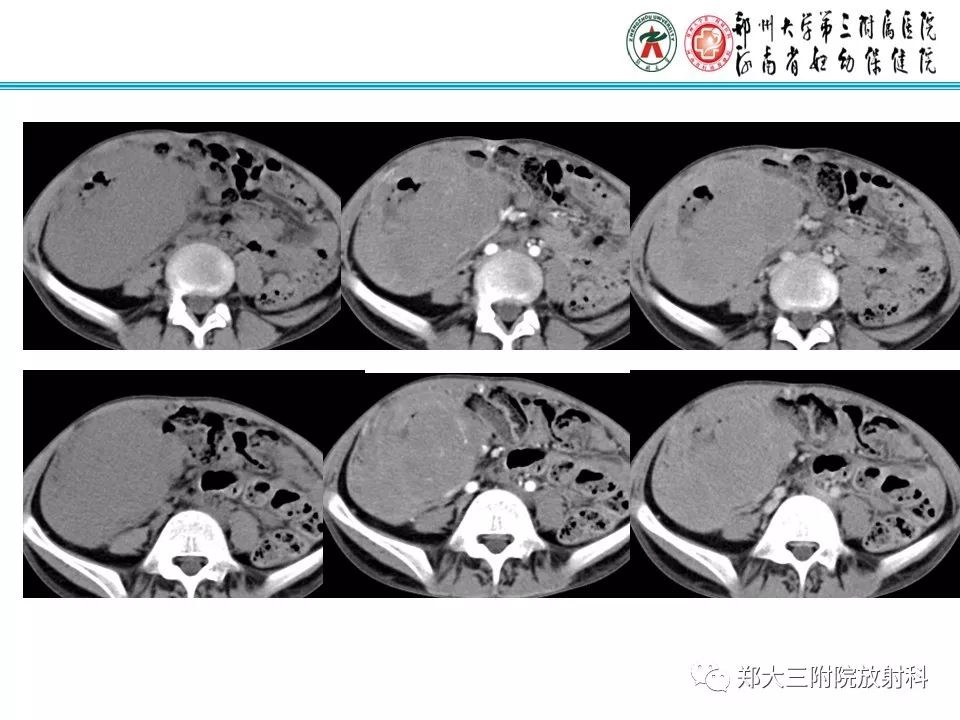 【PPT】小儿腹部伯基特Burkitt's淋巴瘤