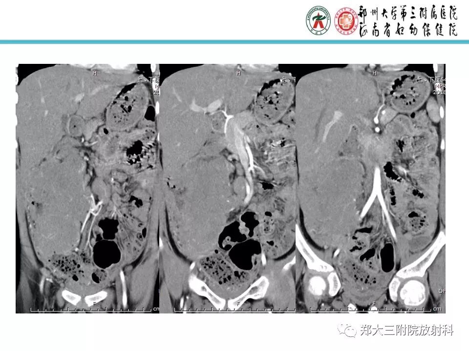 【PPT】小儿腹部伯基特Burkitt's淋巴瘤