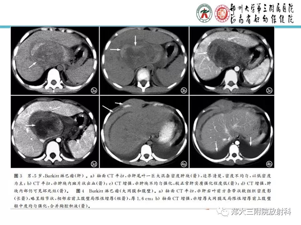 【PPT】小儿腹部伯基特Burkitt's淋巴瘤