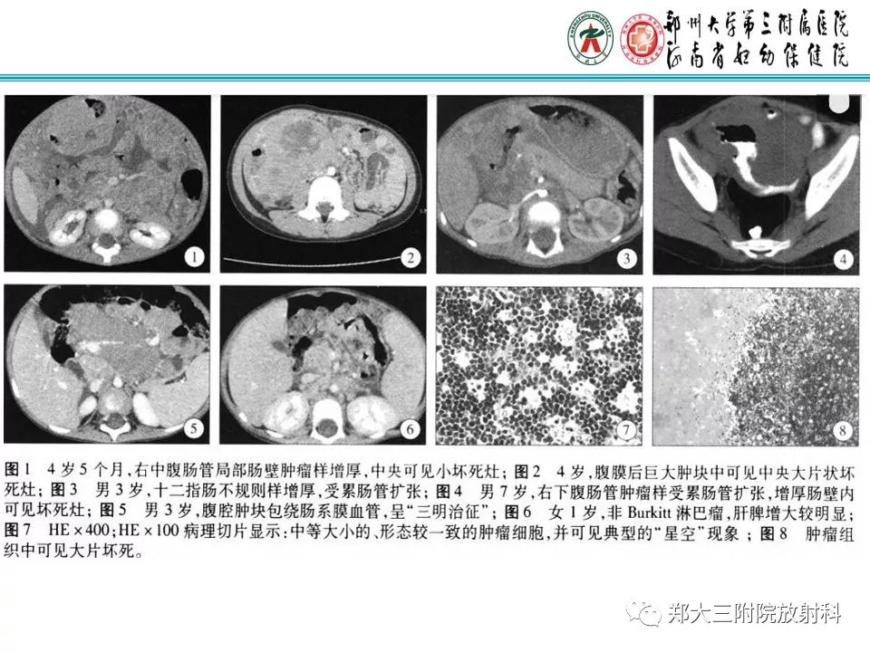 【PPT】小儿腹部伯基特Burkitt's淋巴瘤