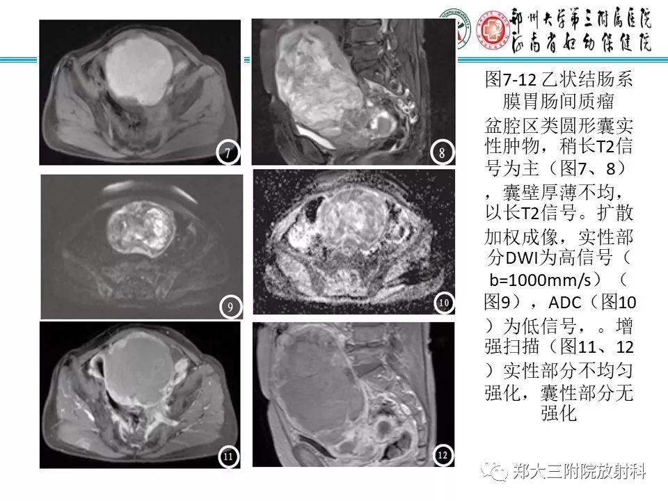 【PPT】小儿腹部伯基特Burkitt's淋巴瘤