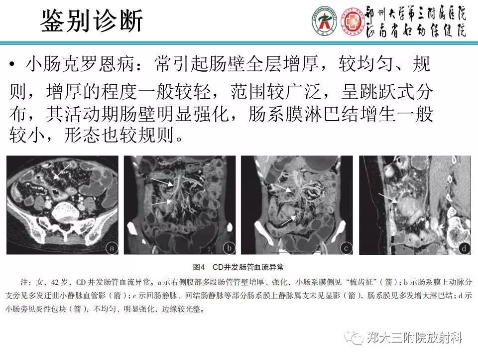 【PPT】小儿腹部伯基特Burkitt's淋巴瘤
