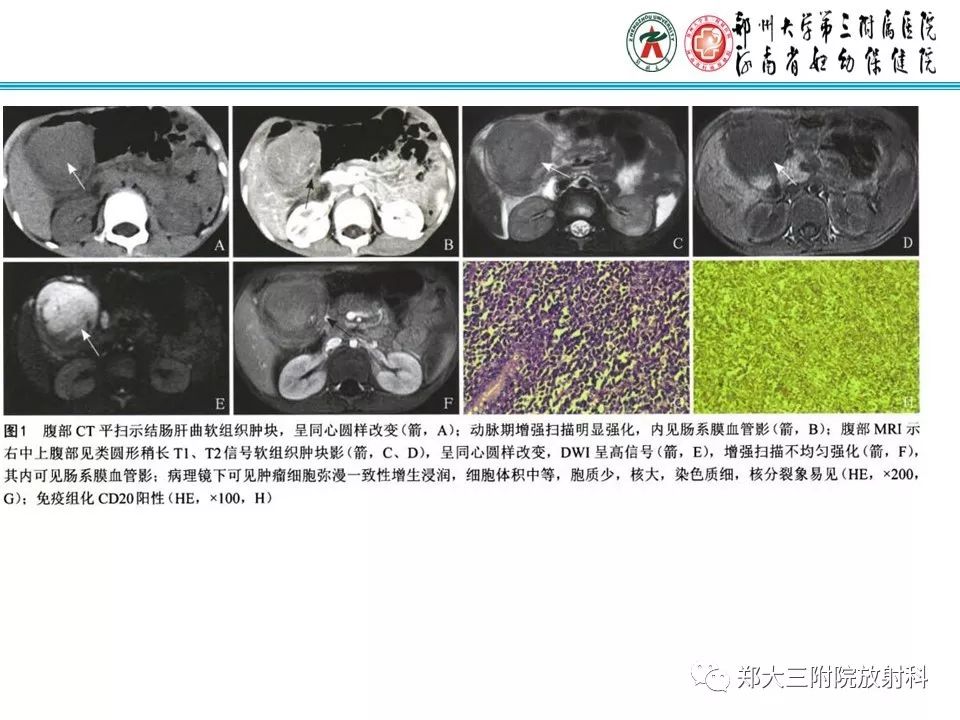 【PPT】小儿腹部伯基特Burkitt's淋巴瘤
